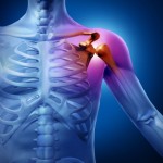 arthritis-pain-shoulder-ca